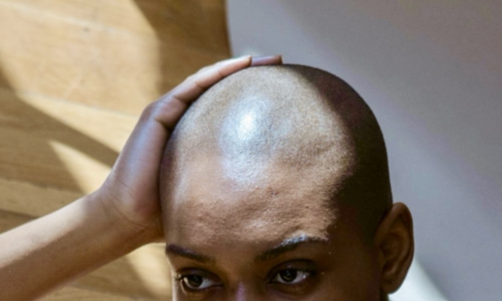 Towanda Braxton, Bald, Alopecia