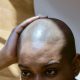 Towanda Braxton, Bald, Alopecia